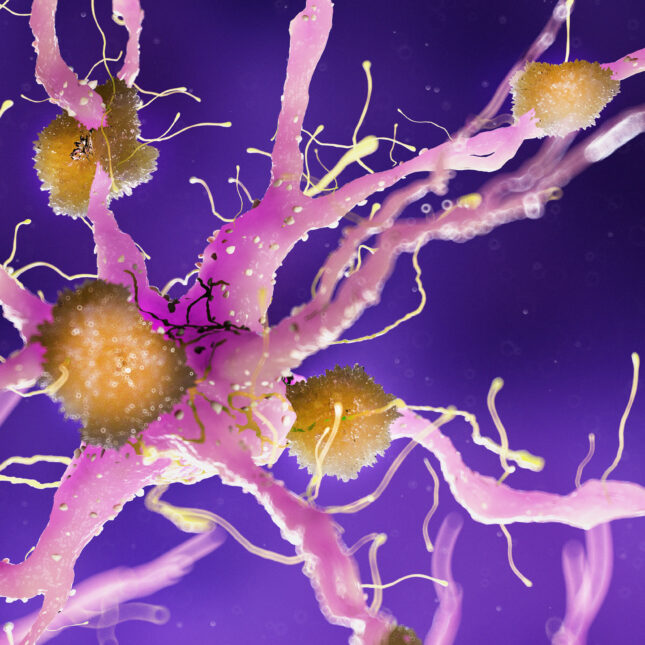 Yellow amyloid plaques attached to nerve cells in Alzheimer's Disease — biotech coverage from STAT