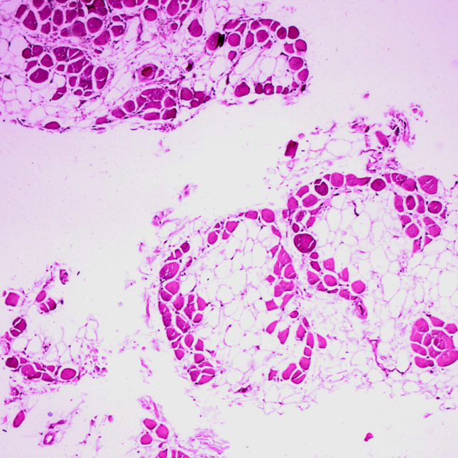 Duchenne muscular dystrophy Histopathology